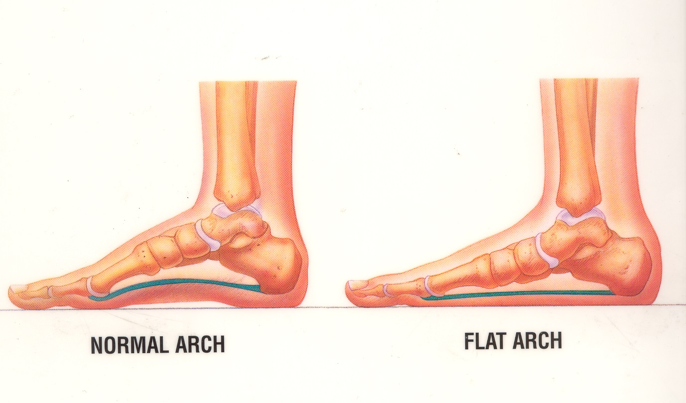 Flat Foot Diagram