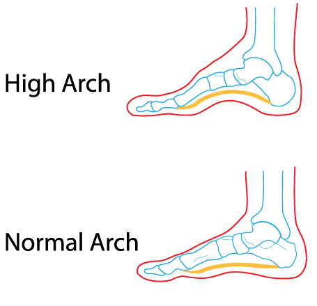 High Arches Diagram